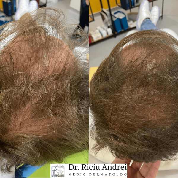 Tratament PRP Scalp Alopecie